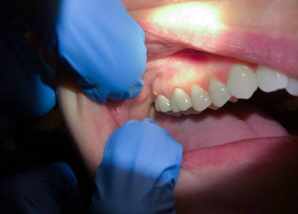 Best Emergency Denture Repair in Robins, IA