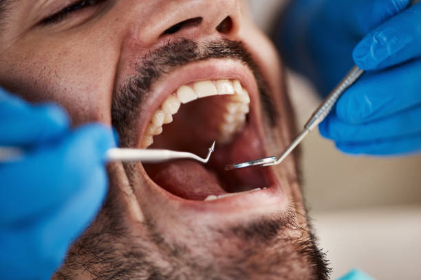 Best Emergency Wisdom Teeth Removal in Robins, IA